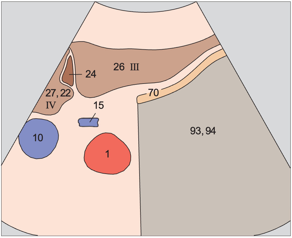 Left lobe of liver, subsegment III, ligamentum teres