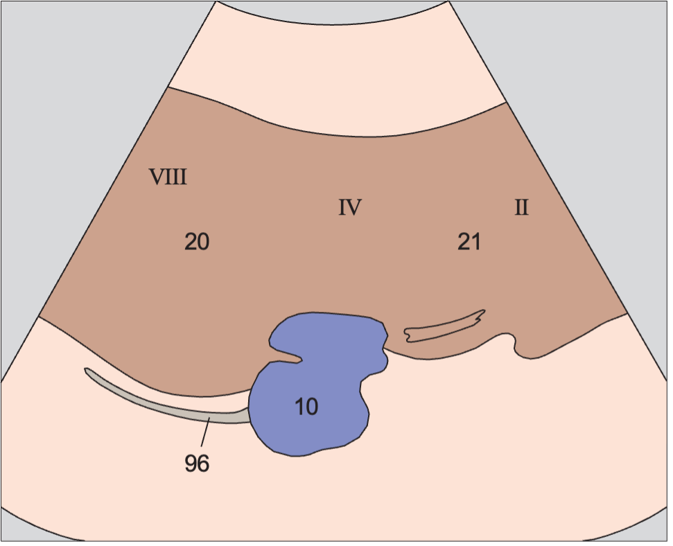 Medial and anterior hepatic segments, opening of hepatic veins