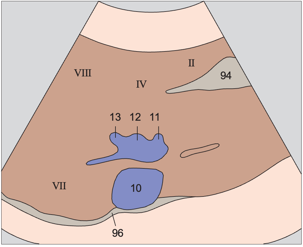 Medial and anterior hepatic segments, opening of hepatic veins