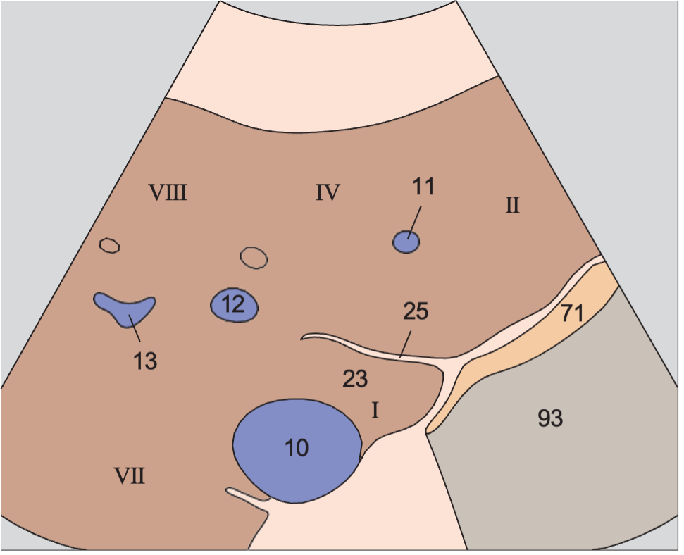 Medial and anterior hepatic segments, caudate lobe