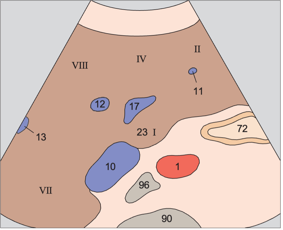 Medial and anterior hepatic segments, left portal vein branch, caudate lobe