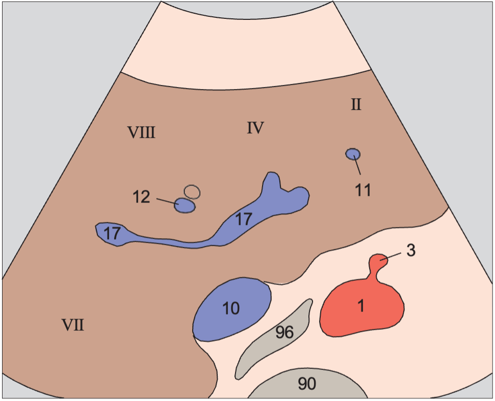 Medial and anterior hepatic segments, left portal vein branch, caudate lobe