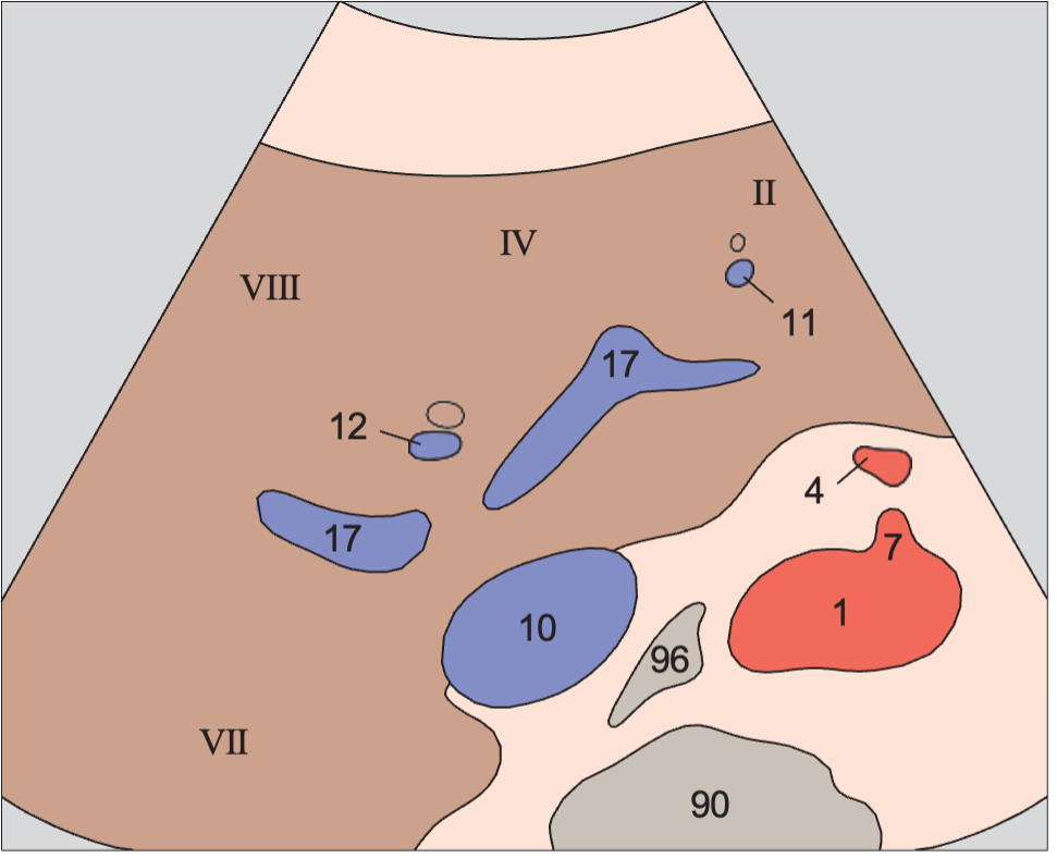 Medial and anterior hepatic segments, bifurcation of portal vein