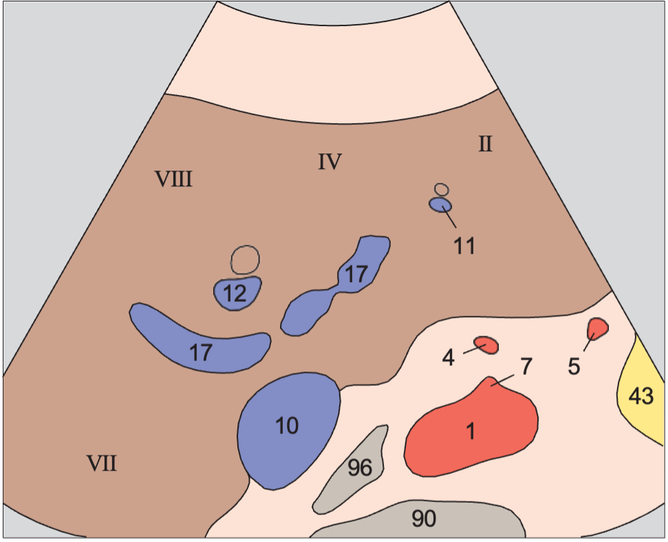 Medial and anterior hepatic segments, bifurcation of portal vein