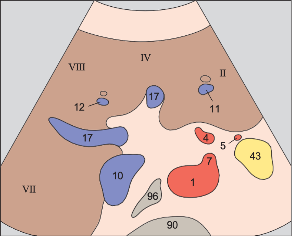 Medial and anterior hepatic segments, right portal vein branch