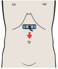 Left renal vein and right renal artery