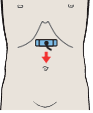 Infrarenal aorta and vena cava
