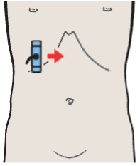 Head of pancreas, hilar vessels, vena cava