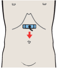 Infrarenal aorta and vena cava