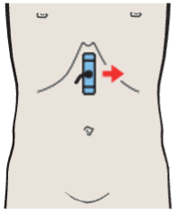Head of pancreas, superior mesenteric vein, uncinate process