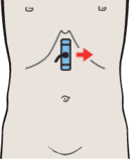 Body of pancreas, splenic vein