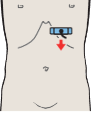 Tail of pancreas, splenic artery