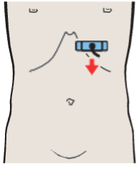 Tail of pancreas, splenic vein