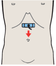 Infrarenal aorta, vena cava, superior mesenteric artery and vein