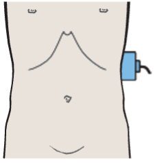 Spleen, tail of pancreas, kidney