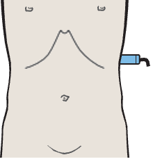Spleen, tail of pancreas, kidney
