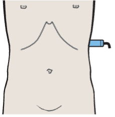 Spleen, tail of pancreas, kidney