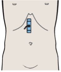 Longitudinal scan of pancreatic duct