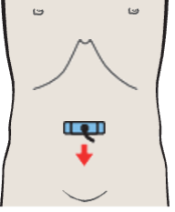 Infrarenal aorta and vena cava