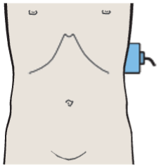 Accessory spleen