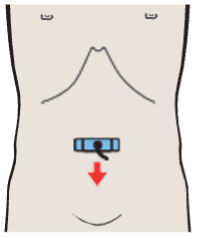 Aortic bifurcation