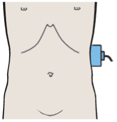 Spleen, tail of pancreas