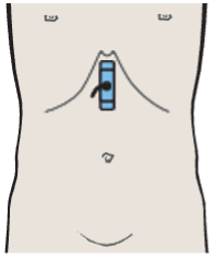 Body of stomach, liver