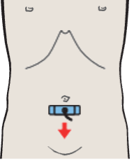 Iliac vessels