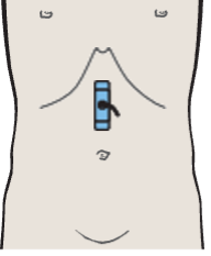 Gastric folds