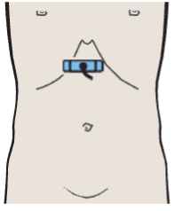 Gastric folds