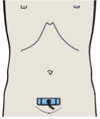 Bladder, ureteral orifices