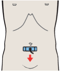 Iliac vessels
