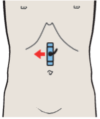 Right renal artery and left renal vein