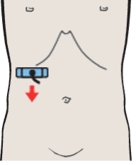 Renal vein at hilum, renal artery