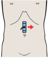 Right renal artery and left renal vein