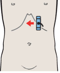 Left lobe of liver, lateral segment, subsegments II and III