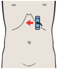 Left lobe of liver, ligamentum teres, boundary between lateral and medial segments