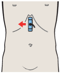 Left hepatic vein, ligamentum teres, boundary between lateral and medial segments, caudate lobe