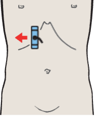 Gallbladder, portal vein, vena cava, boundary between medial and anterior segments