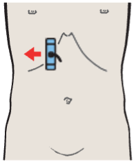 Middle hepatic vein, boundary between medial and anterior segments