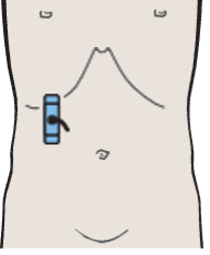 Posterior segment, subsegments VII and VI