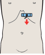 Left lobe of liver, lateral segment, heart