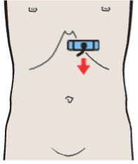 Left lobe of liver, subsegment III, ligamentum teres