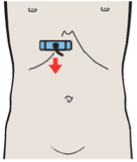 Medial and anterior hepatic segments, opening of hepatic veins