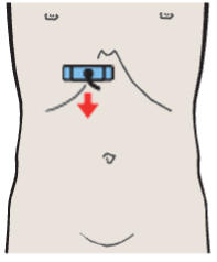 Medial and anterior hepatic segments, right and left portal vein branches